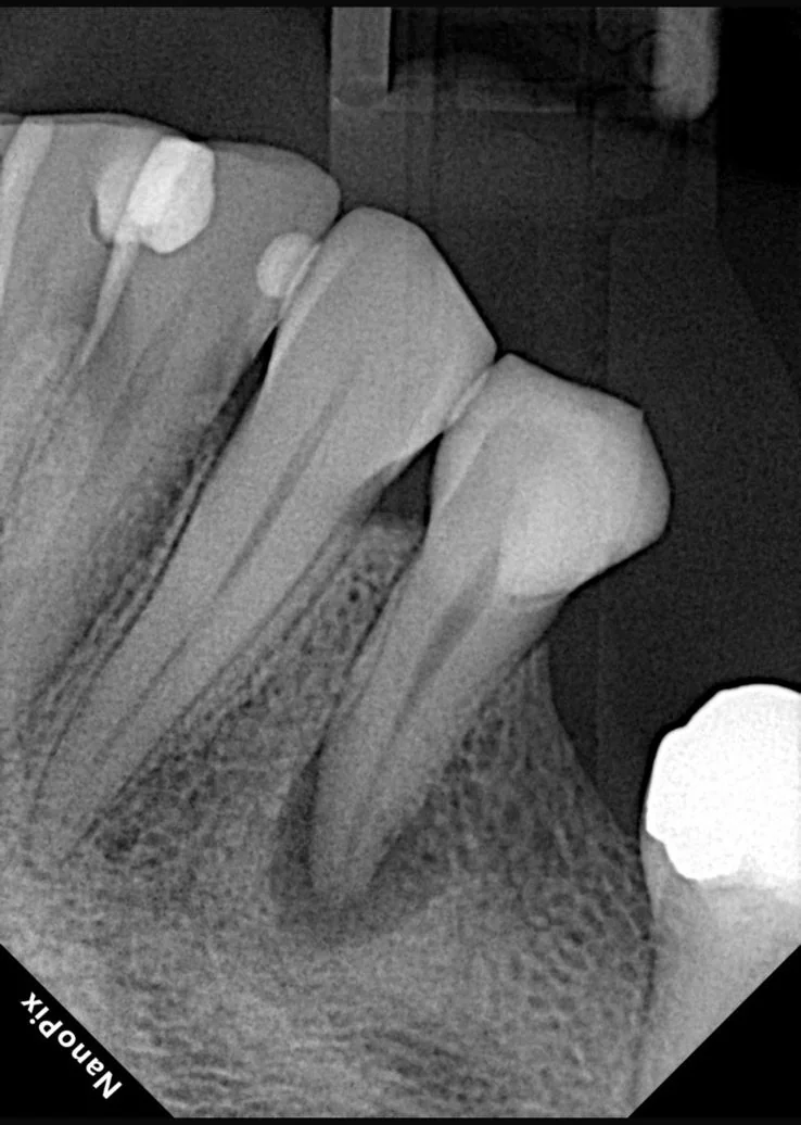 Endodontia caso 1 — pré-operatório, Dra. Katiane Ghinzelli
