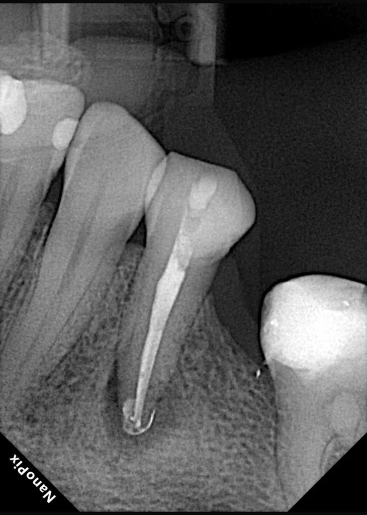 Endodontia caso 1 — recém obturado, Dra. Katiane Ghinzelli