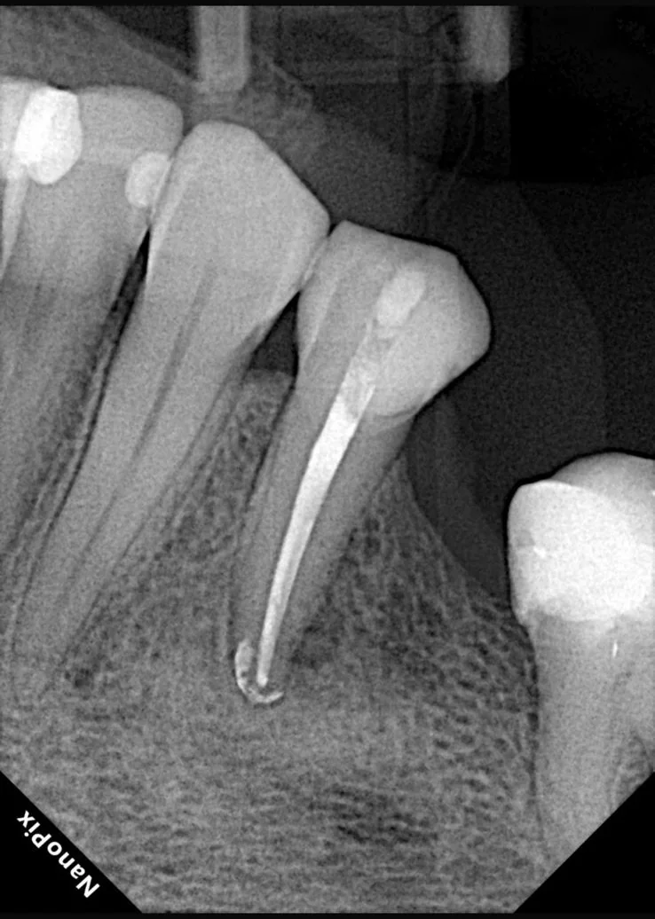 Endodontia caso 1 — proservação (acompanhamento), Dra. Katiane Ghinzelli