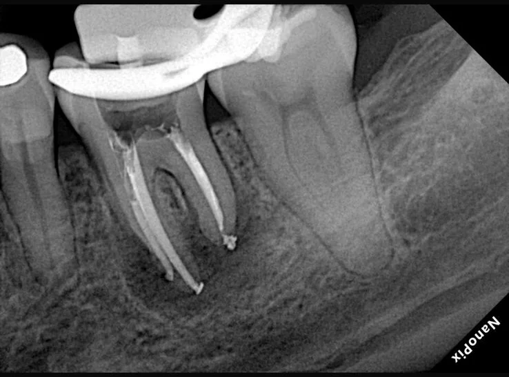 Endodontia caso 2 — pré-operatório, Dra. Katiane Ghinzelli