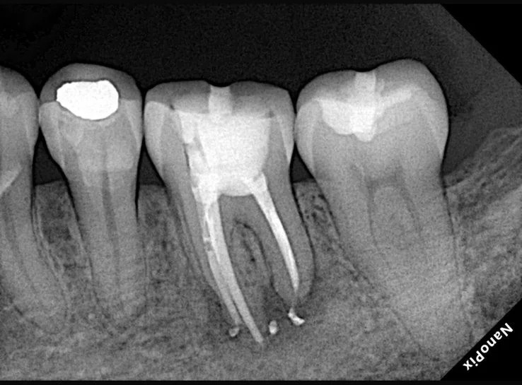 Endodontia caso 2 — recém obturado, Dra. Katiane Ghinzelli