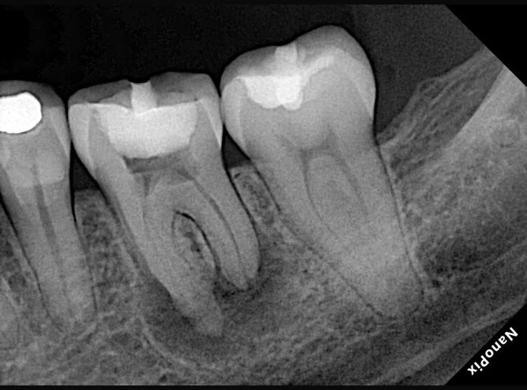 Endodontia caso 2 — proservação (acompanhamento), Dra. Katiane Ghinzelli