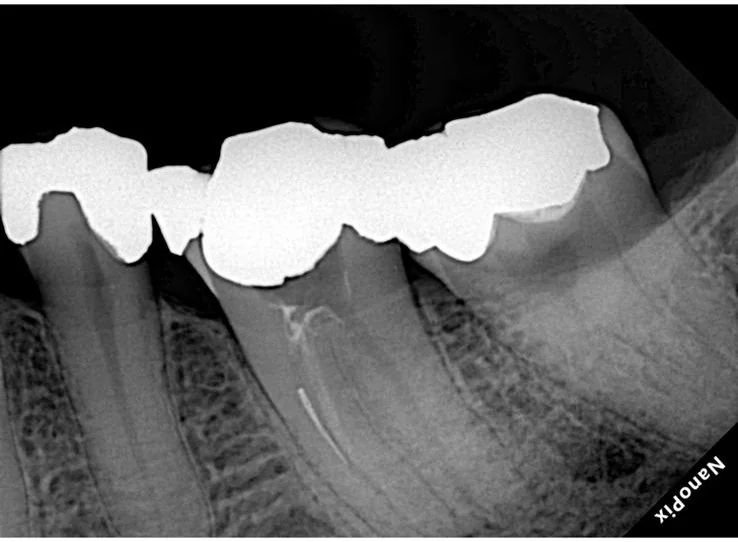 Endodontia caso 3 — remoção de lima fraturada, antes, Dra. Katiane Ghinzelli