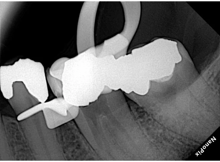 Endodontia caso 3 — remoção de lima fraturada, depois, Dra. Katiane Ghinzelli