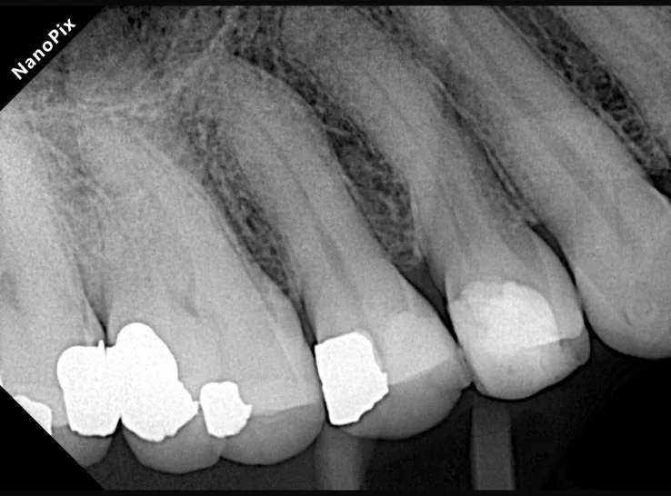 Endodontia caso 4 — curvatura complexa, pré-operatório, Dra. Katiane Ghinzelli