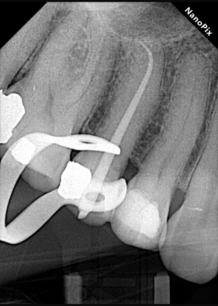 Endodontia caso 4 — curvatura complexa, recém obturado, Dra. Katiane Ghinzelli