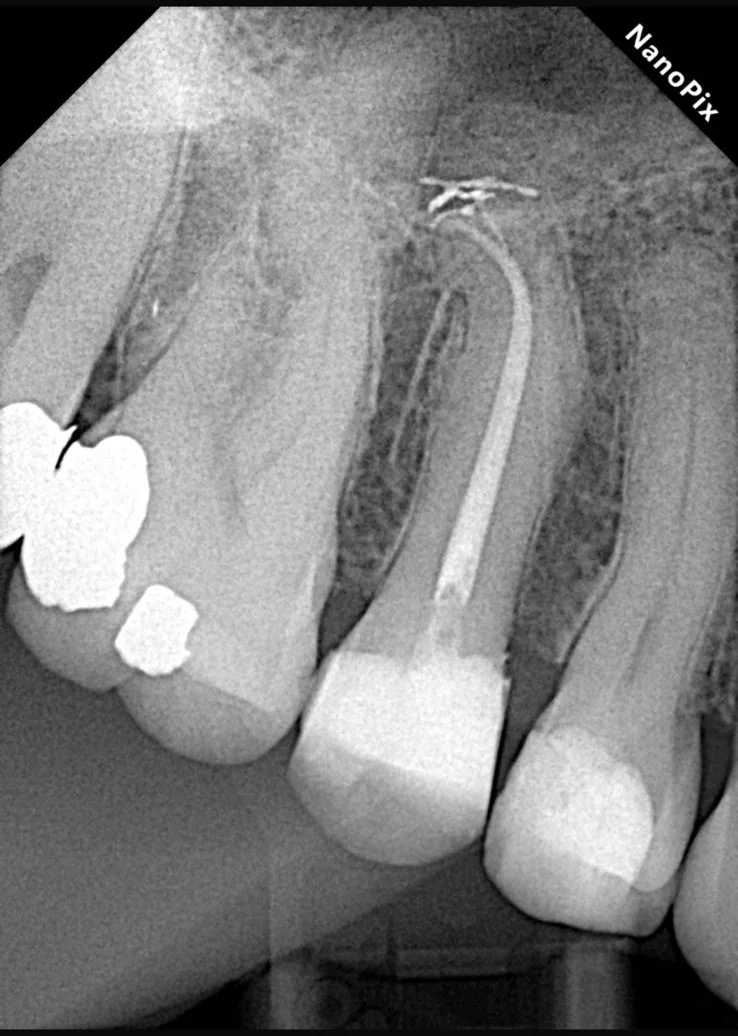 Endodontia caso 4 — curvatura complexa, proservação, Dra. Katiane Ghinzelli
