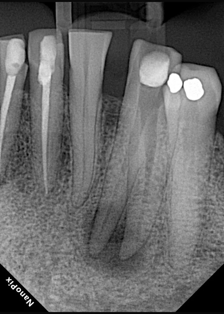 Endodontia caso 5 — complexidades anatômicas, pré-operatório, Dra. Katiane Ghinzelli