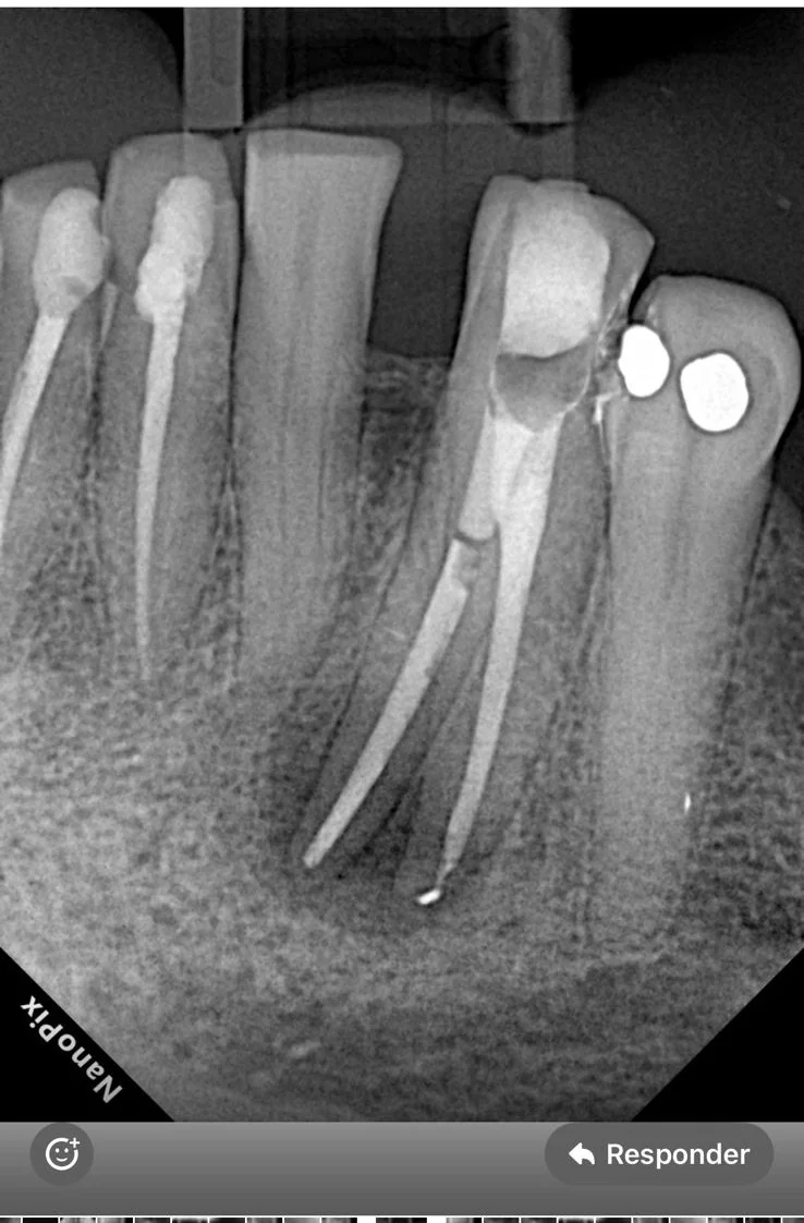 Endodontia caso 5 — complexidades anatômicas, recém obturado, Dra. Katiane Ghinzelli