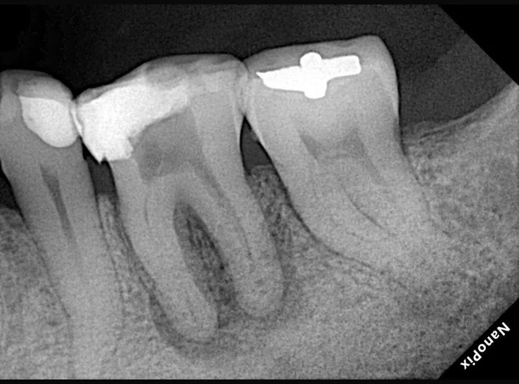 Endodontia caso 6 — lesão extensa, pré-operatório, Dra. Katiane Ghinzelli