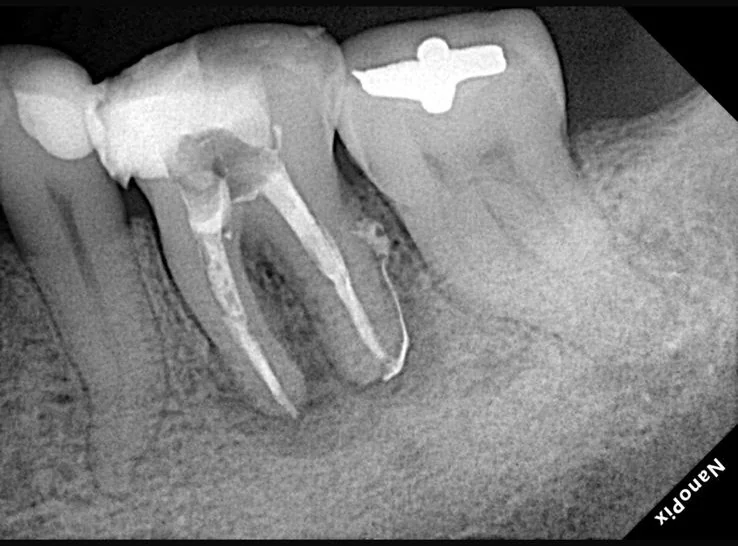 Endodontia caso 7 — lesão extensa, recém obturado, Dra. Katiane Ghinzelli