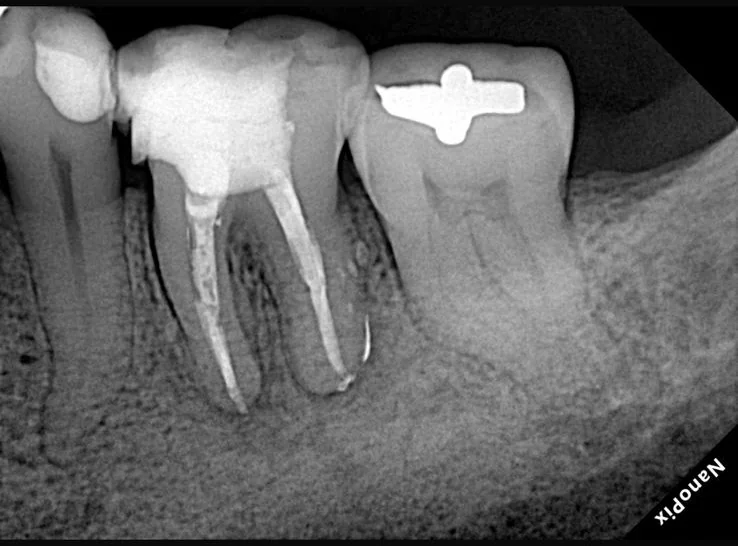 Endodontia caso 7 — lesão extensa, proservação, Dra. Katiane Ghinzelli