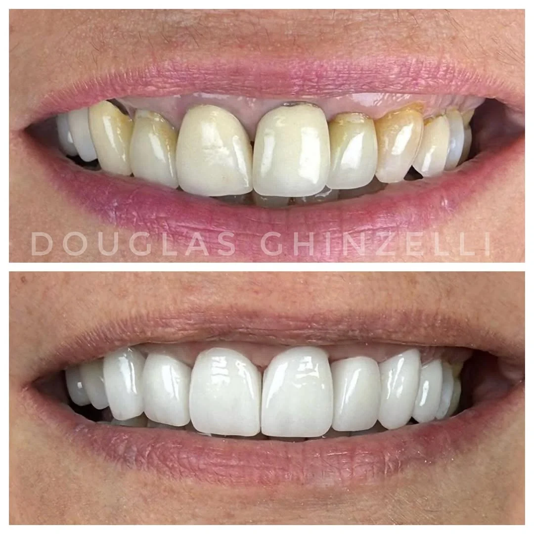 Antes e depois implante dentário — caso 1, Dr. Douglas Ghinzelli, Pró Sorrir