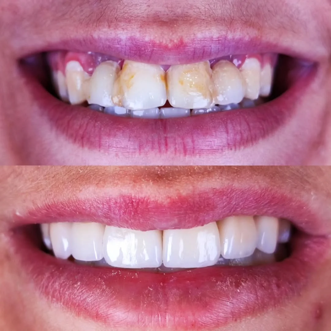 Implante dentário estético antes e depois — caso 3, Dr. Douglas Ghinzelli
