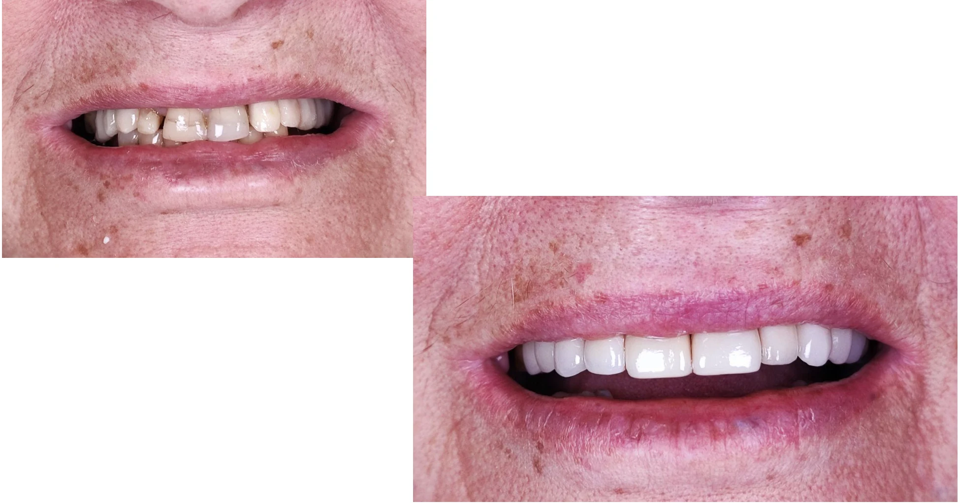 Antes e depois de reabilitação com implante — caso 9, Dr. Douglas Ghinzelli