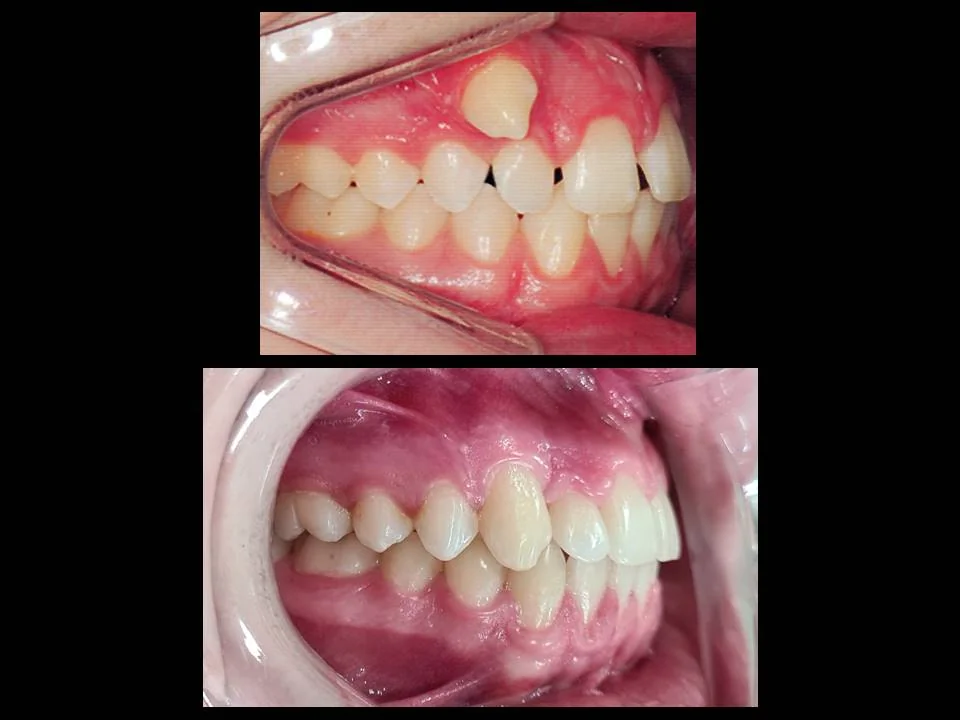 Resultado de alinhamento dental — caso 2, Dr. Guilherme Ghinzelli