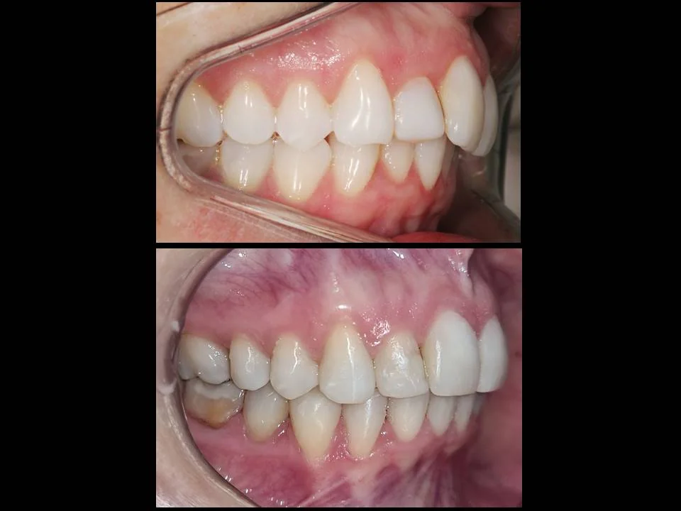 Sorriso após tratamento ortodôntico — caso 6, Dr. Guilherme Ghinzelli