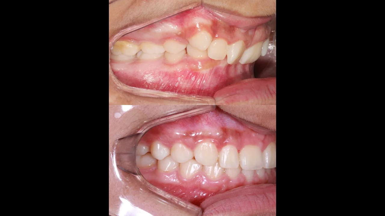 Antes e depois com alinhadores invisíveis — caso 8, Dr. Guilherme Ghinzelli