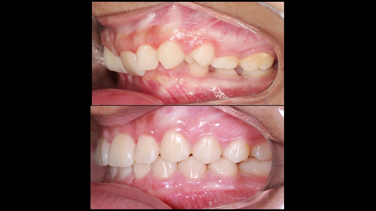 Correção de apinhamento dental — caso 9, Dr. Guilherme Ghinzelli