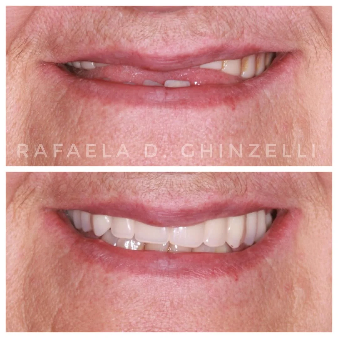 Resultado de gengivoplastia — caso 2, Dra. Rafaela Dal Ponte Ghinzelli